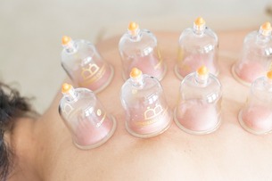 Dry Cupping Therapy - Aura Serenity